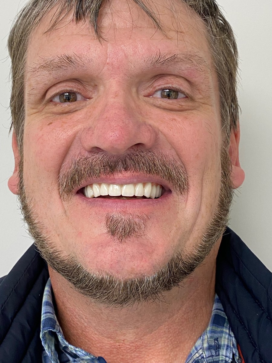 Same patient after All-on-4 — full restored bright smile