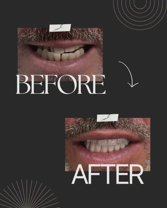 Before and after All-on-4 — chipped front teeth restored to even, bright smile