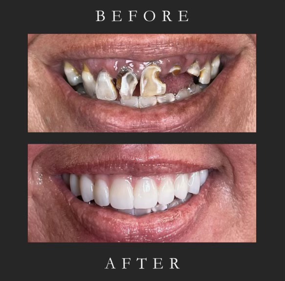 Before and after All-on-4 — severely worn teeth restored to full bright smile